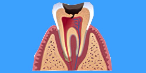 Dentistes Nimes carie dentaire